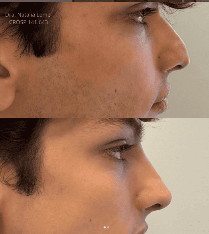 Antes e depois de rinomodelacao, depoimento do paciente da Dra. Natalia Leme, Pedro Henrique.